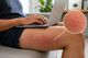 Person using a laptop on their bare thighs with a visible toasted skin syndrome heat rash on the leg